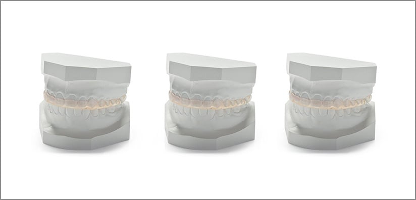 Bruxism Mouth Guards 104