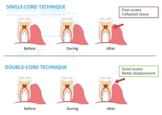 Single Cord Technique and Double Cord Technique - DDS Dental Lab Single Cord Technique and Double Cord Technique - DDS Dental Lab