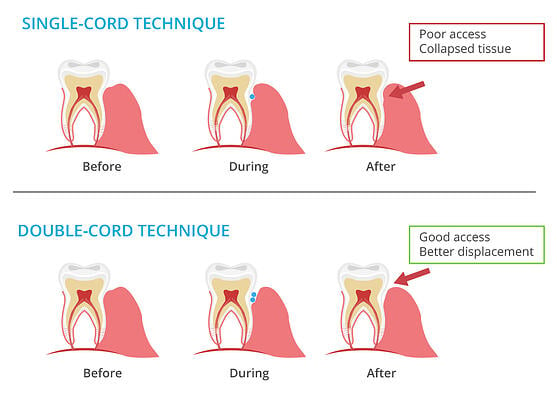 Single Cord Technique and Double Cord Technique - DDS Dental Lab