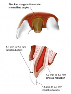 Anterior Crowns