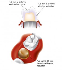 Posterior Crowns