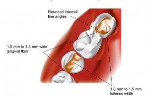 Inlays/Onlays Inlays/Onlays