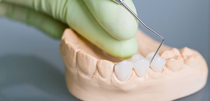 Blog_FIXED IMPLANT BRIDGES- Treatment Details