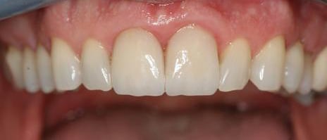 Soft-tissue response to well-fitting all-ceramic restorations in Dentistry