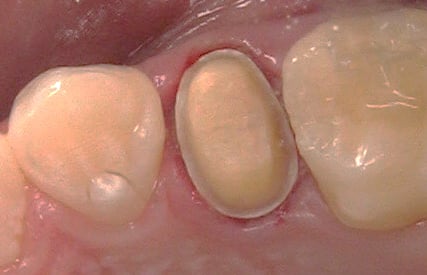 2-plane lingual cusp reduction of a maxillary premolar in Dentistry