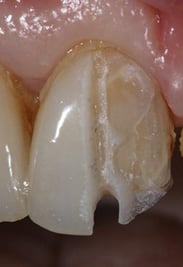 Tooth preparation - depth grooves of known diameters