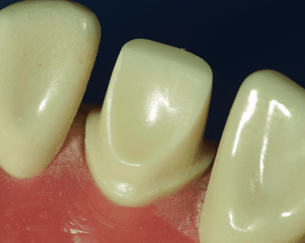 Optimal clinical margins and digital dental scans