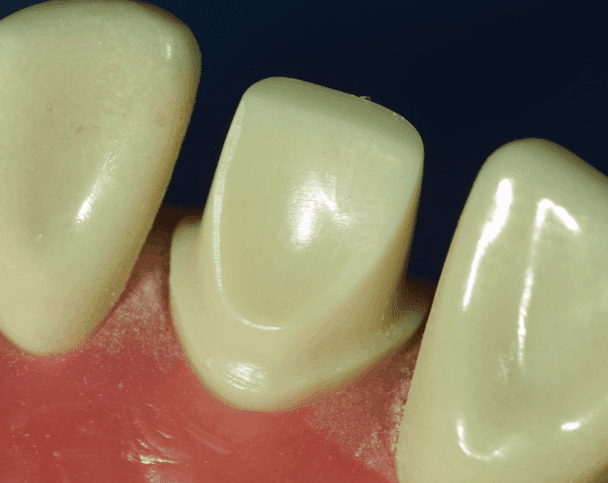 Bevel-chamfer margin | Dentistry