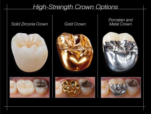 High Strength Dental Crown Options