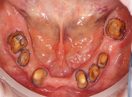 Retracting Soft Tissue in Dentistry