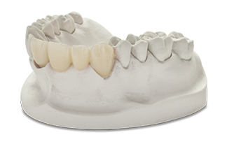 All-Ceramic / All-Porcelain