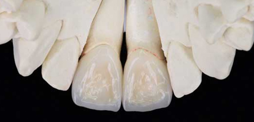 comparison-chart-layered-vs-solid-zirconia-applications