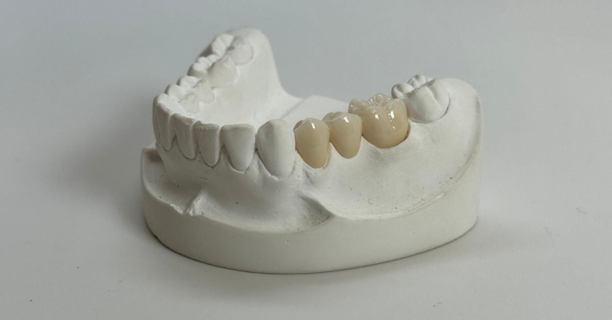 Trends in Material Considerations for Permanent Crowns