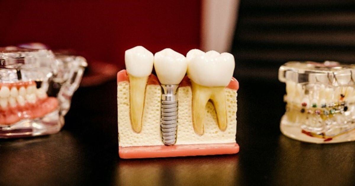 How To Explain Dental Implant Healing Stages to Patients