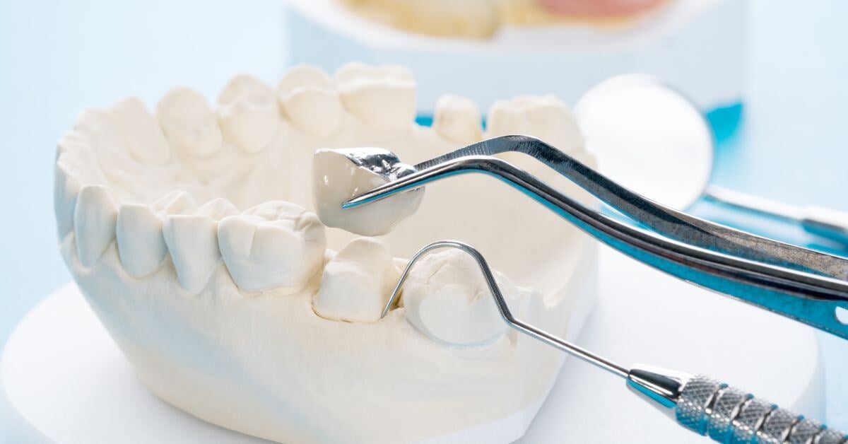 Crown & Bridge Preparations: What Dentists Should Know