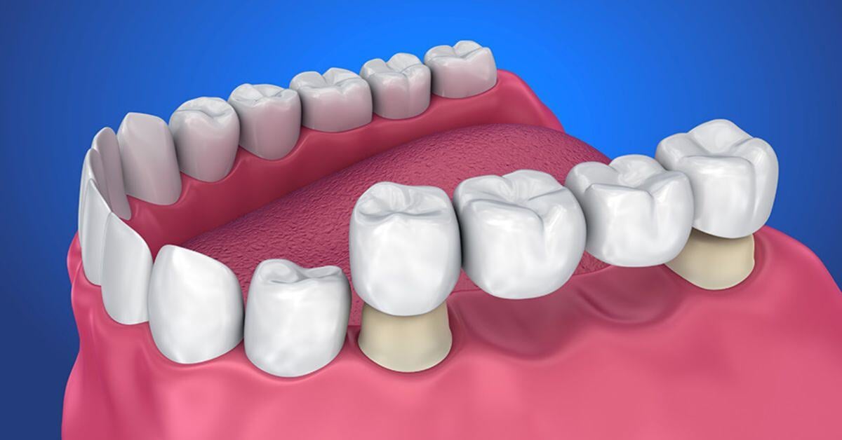 The Ultimate Dentist’s Guide to Crown & Bridge