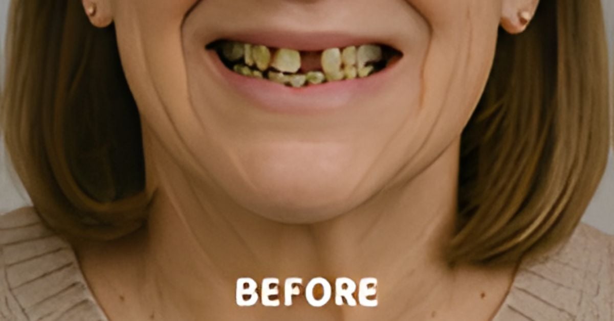 What To Know About Using Implants for Full Mouth Restoration