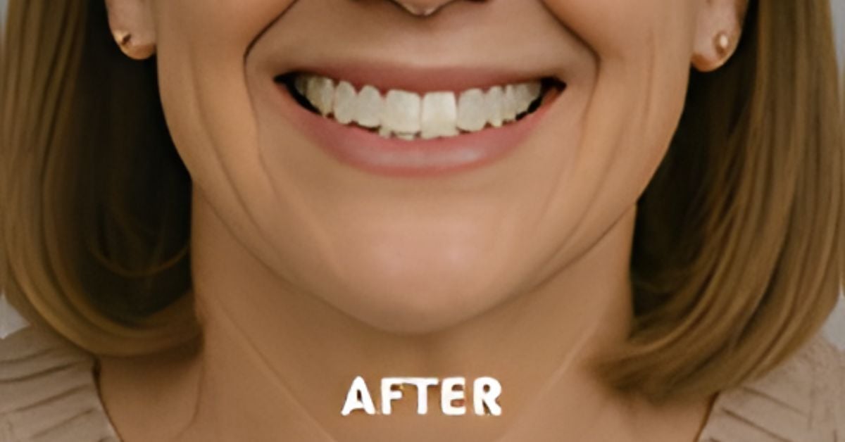 What To Know About Using Implants for Full Mouth Restoration
