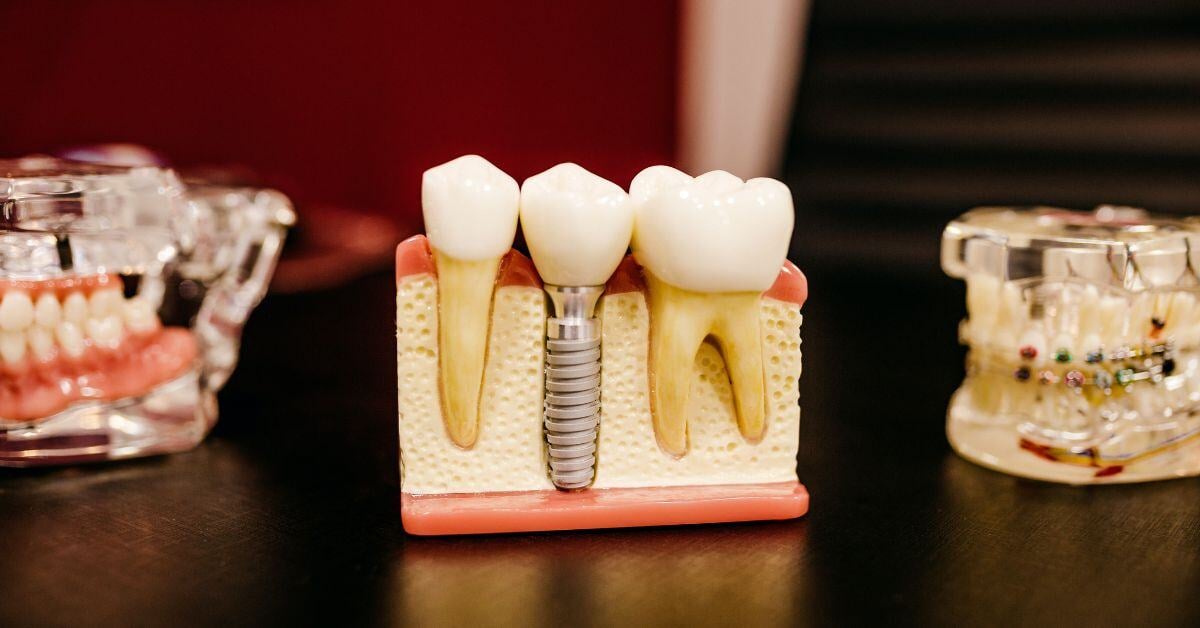 Dental Implant Treatment Plan Conversions for Your Practice