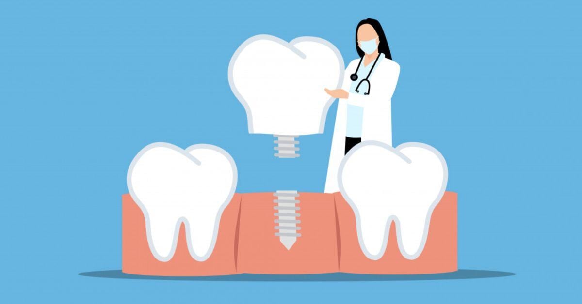 Dental Implant Treatment Plan Conversions for Your Practice