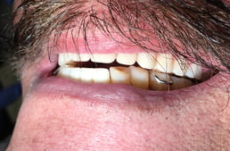 Anterior teeth are too open due to posterior interference