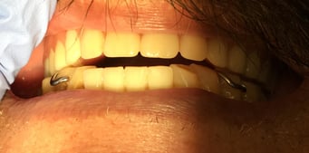 Anterior teeth are too open due to posterior interference