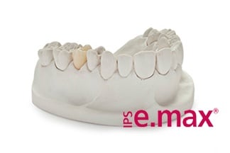 All Ceramics IPS EMax | Crowns & Bridges