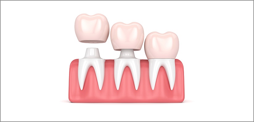 cement used for dental crowns