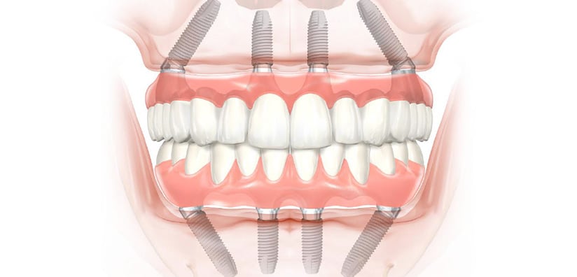 Why All On Four Dental Implant Procedures Are Easier Than You Might Think