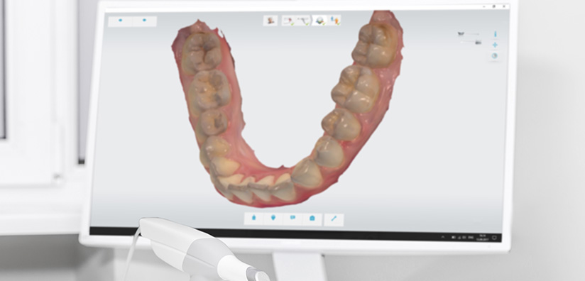 digital dental impression technology