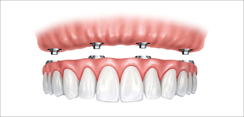 Full Zirconia Implant Retained Prosthesis Step By Step Instructions