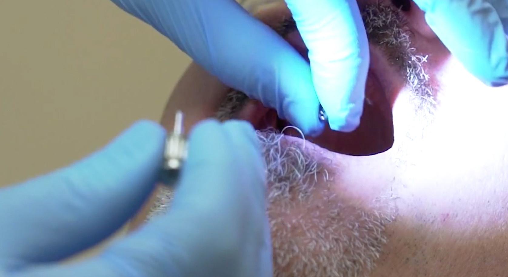 Placing a Multi-Unit Abutment