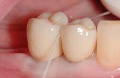 Dental Crown Floss to test interproximal contact