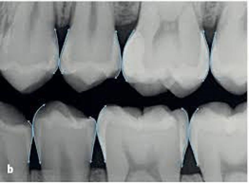 Dental Crown Margins Contact Areas