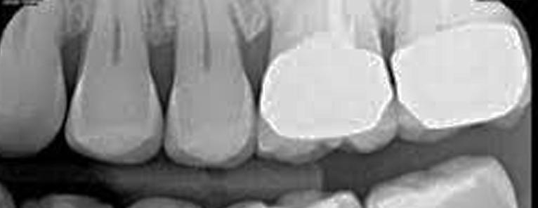 Dental Crown Bitewing radiograph