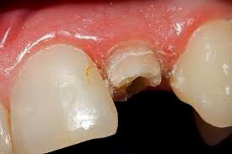 Dental Crown Tooth Trauma