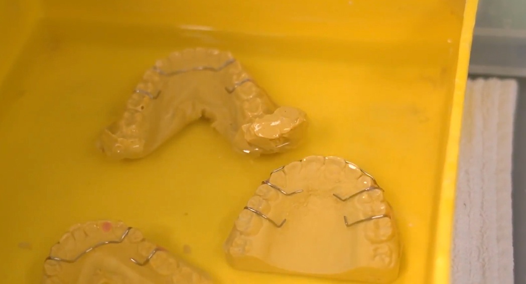 Hawley Retainer Instructions.pdf NINE STEPS TO CREATING A HAWLEY RETAINER