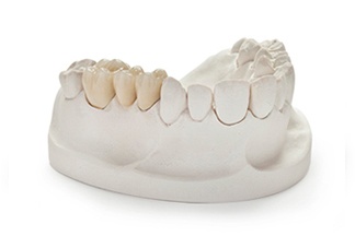 PFM Dental Crown White  Hi Noble