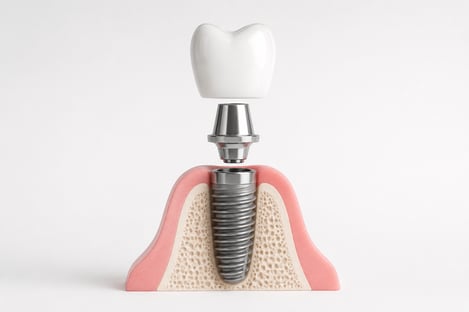 implant