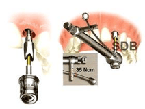 Dental Implant Insertion Torque