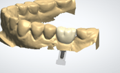 digitally designed zirconia dental crown on the CAD-designed titanium abutment above.