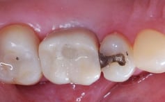 PFM Dental Crown in Mouth