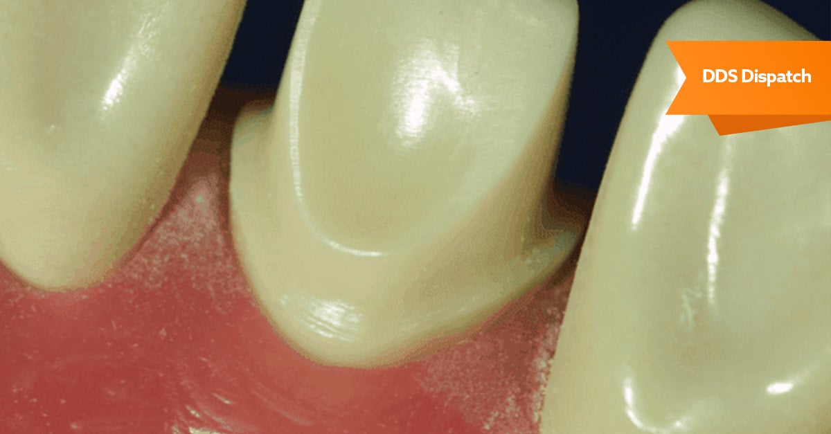 Optimal clinical margins and digital dental scans