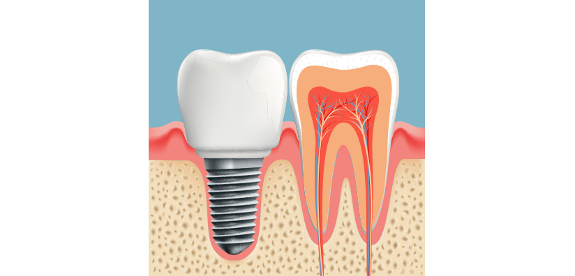 STUDY: Natural Tooth Preservation Versus Extraction and Implant Placement