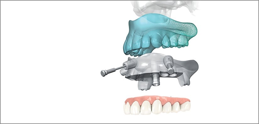 ADVANTAGES AND BENEFITS OF COMPUTER-GUIDED IMPLANT SURGERY