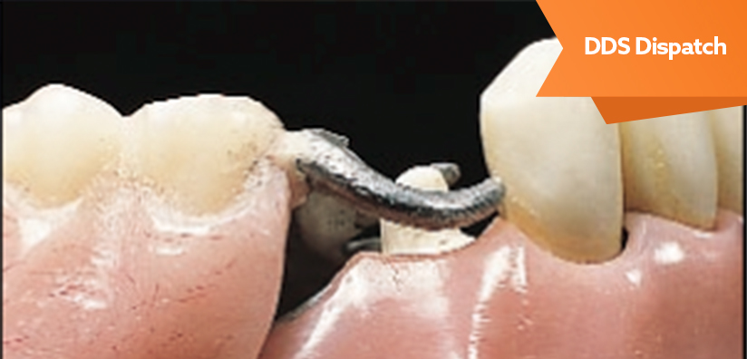 FABRICATING A CROWN UNDER AN EXISTING​ ​REMOVABLE PARTIAL DENTURE