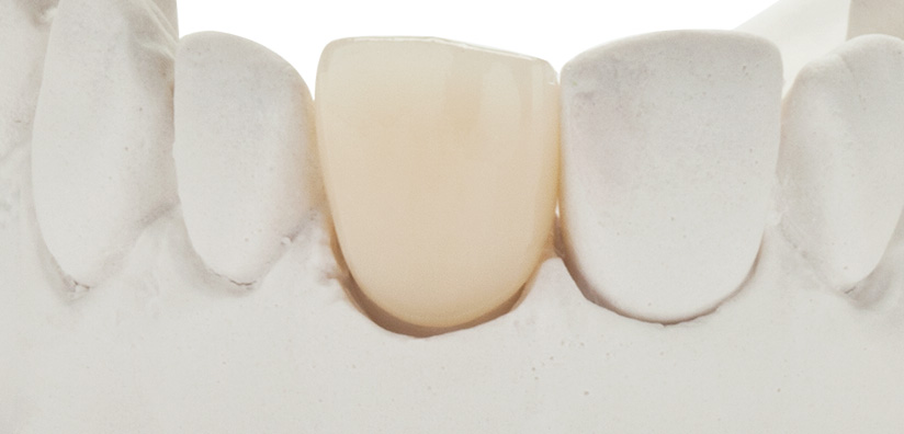 LITTLE CHANGES THAT WILL MAKE A BIG DIFFERENCE WHEN PLACING ZIRCONIA DENTAL CROWNS
