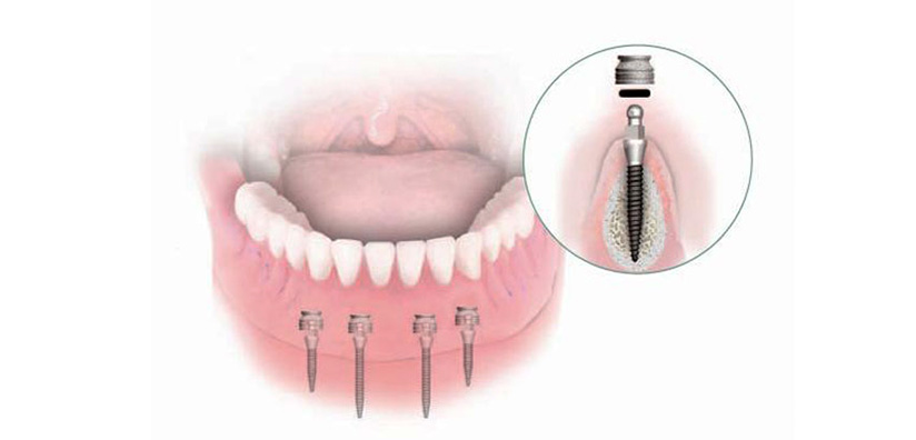 MINI IMPLANTS FOR ORTHODONTIC ANCHORAGE