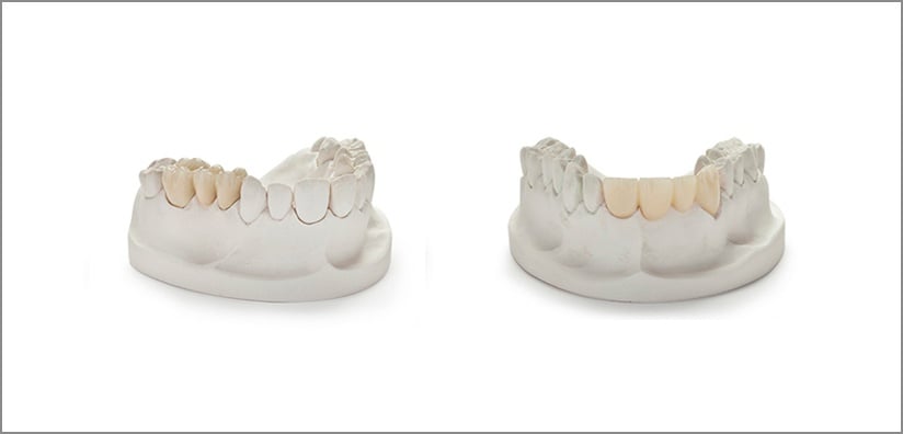 PFM VS Zirconia: Which Material is Better?