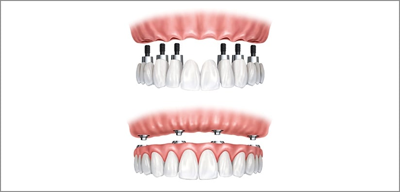 WHEN TO RECOMMEND IMPLANT OVERDENTURES